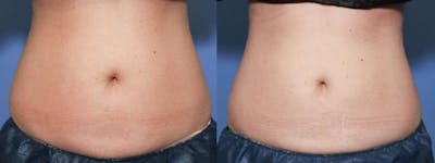 Body Before & After Gallery - Patient 58490612 - Image 1