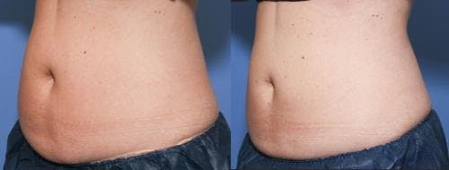 Body Before & After Gallery - Patient 58490612 - Image 2