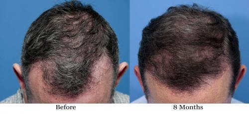 NeoGraft Hair Restoration Before & After Gallery - Patient 58490614 - Image 7