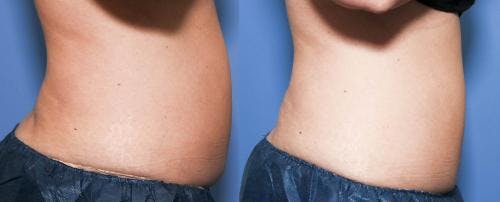 Body Before & After Gallery - Patient 58490612 - Image 3