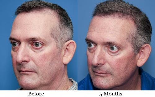 NeoGraft Hair Restoration Before & After Gallery - Patient 58490614 - Image 8