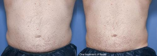 Body Before & After Gallery - Patient 58490613 - Image 1