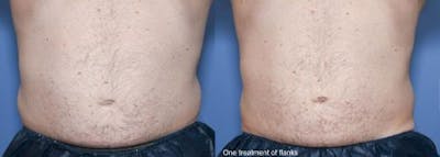 Body Before & After Gallery - Patient 58490613 - Image 1