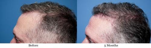 NeoGraft Hair Restoration Before & After Gallery - Patient 58490614 - Image 9