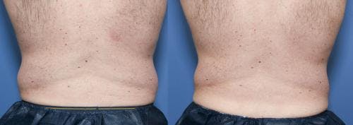Body Before & After Gallery - Patient 58490613 - Image 2