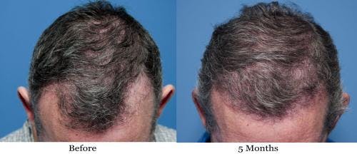 NeoGraft Hair Restoration Before & After Gallery - Patient 58490614 - Image 10