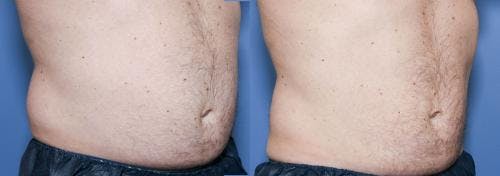Body Before & After Gallery - Patient 58490613 - Image 3