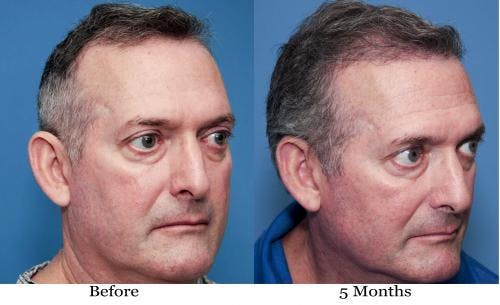 NeoGraft Hair Restoration Before & After Gallery - Patient 58490614 - Image 11