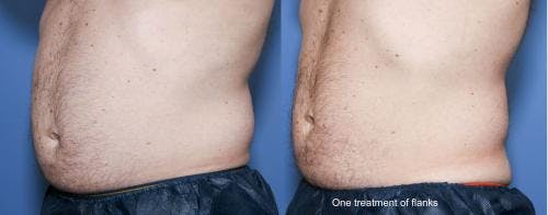 Body Before & After Gallery - Patient 58490613 - Image 4