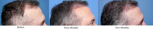 NeoGraft Hair Restoration Before & After Gallery - Patient 58490614 - Image 12
