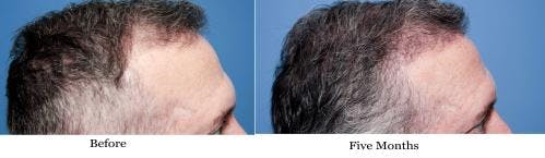 NeoGraft Hair Restoration Before & After Gallery - Patient 58490614 - Image 13