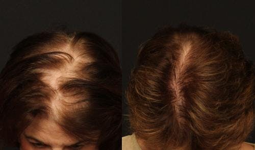 NeoGraft Hair Restoration Before & After Gallery - Patient 58490615 - Image 1