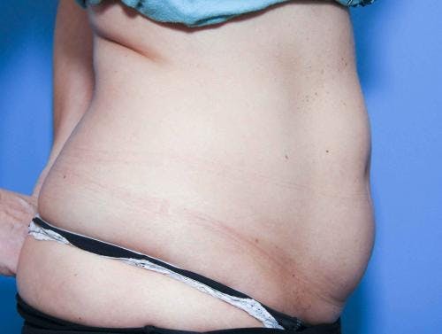 Body Before & After Gallery - Patient 58490616 - Image 3