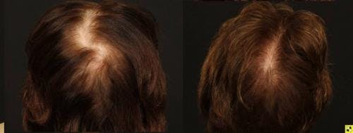 NeoGraft Hair Restoration Before & After Gallery - Patient 58490615 - Image 2