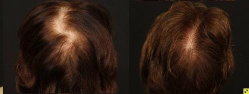 Female Hair Restoration Before & After Gallery - Patient 131385331 - Image 2