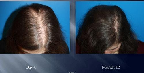 Female Hair Restoration Before & After Gallery - Patient 131385330 - Image 1
