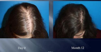 NeoGraft Hair Restoration Before & After Gallery - Patient 58490617 - Image 1