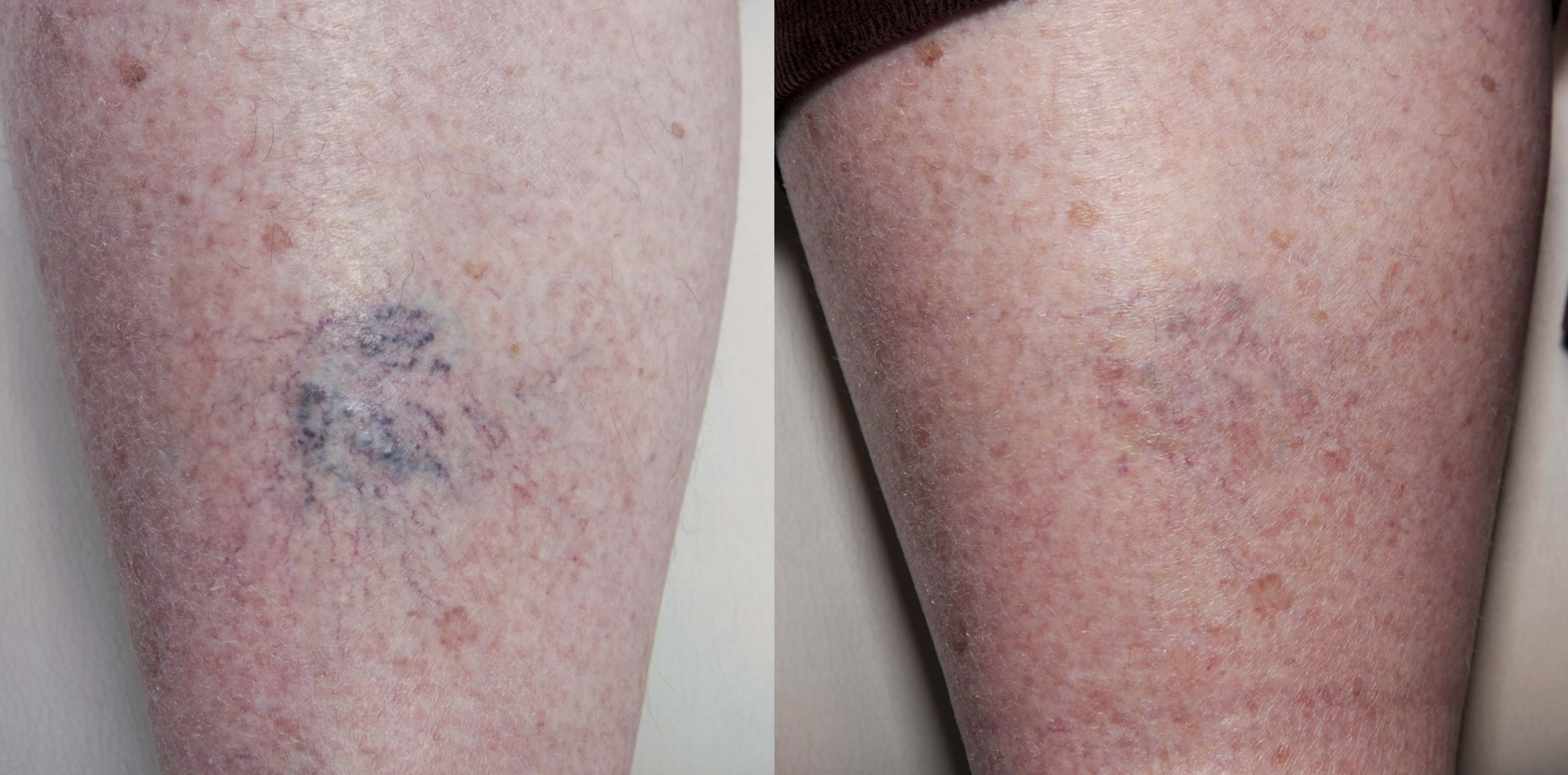 Spider Veins Vs Varicose Veins Treatment: What's the Difference?, Blog