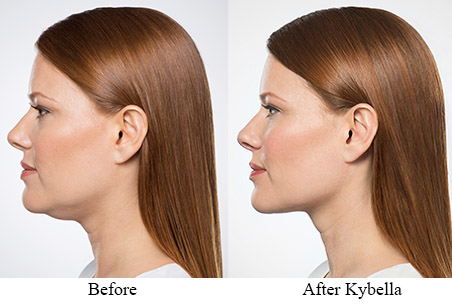 AboutKybella-Before