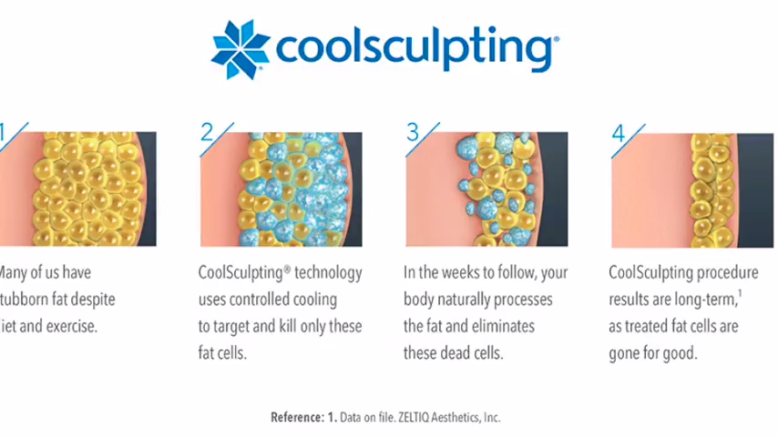 an animation showing the different stages of the process behind CoolSculpting