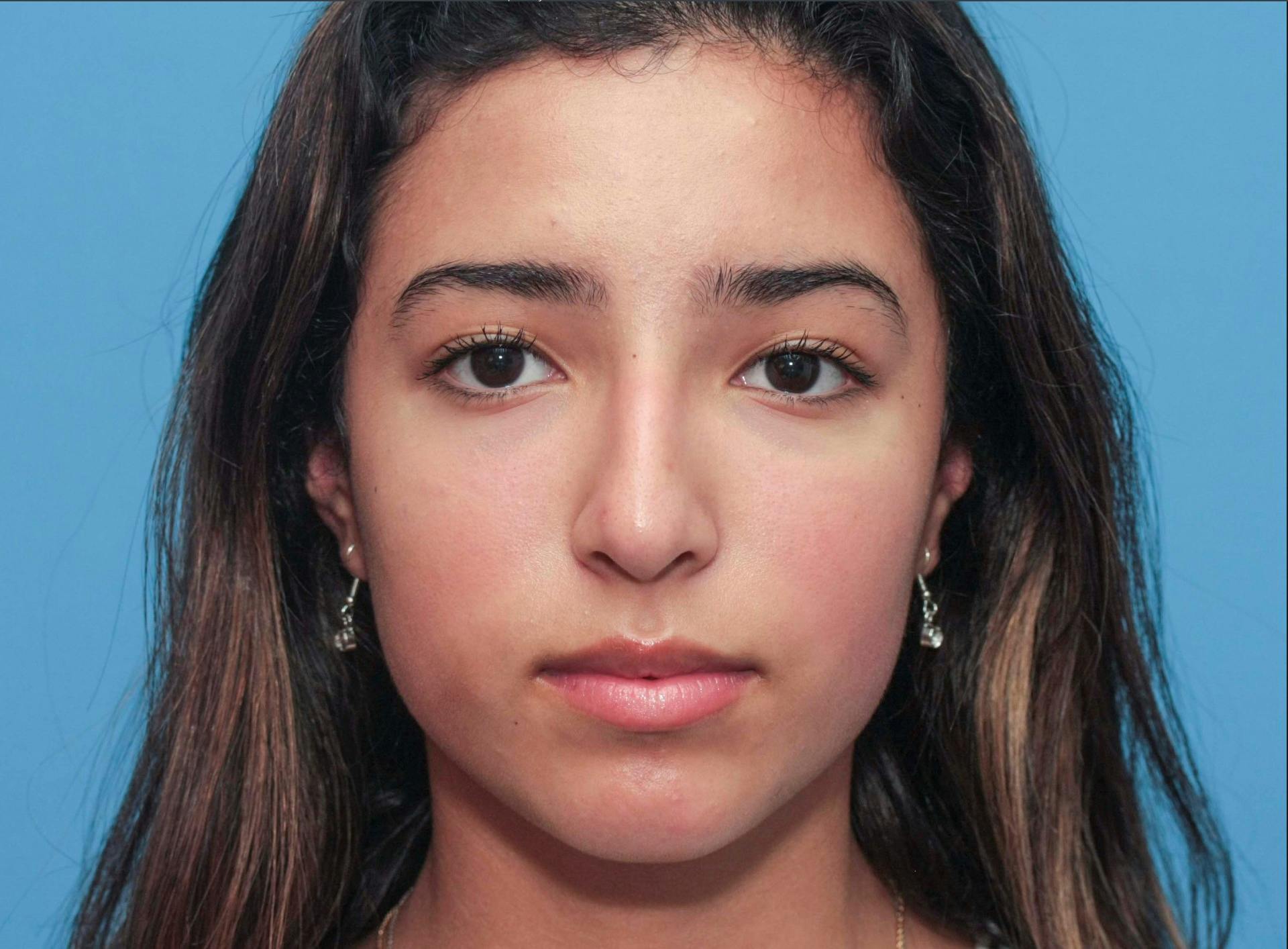 Rhinoplasty Before & After Gallery - Patient 64995415 - Image 5