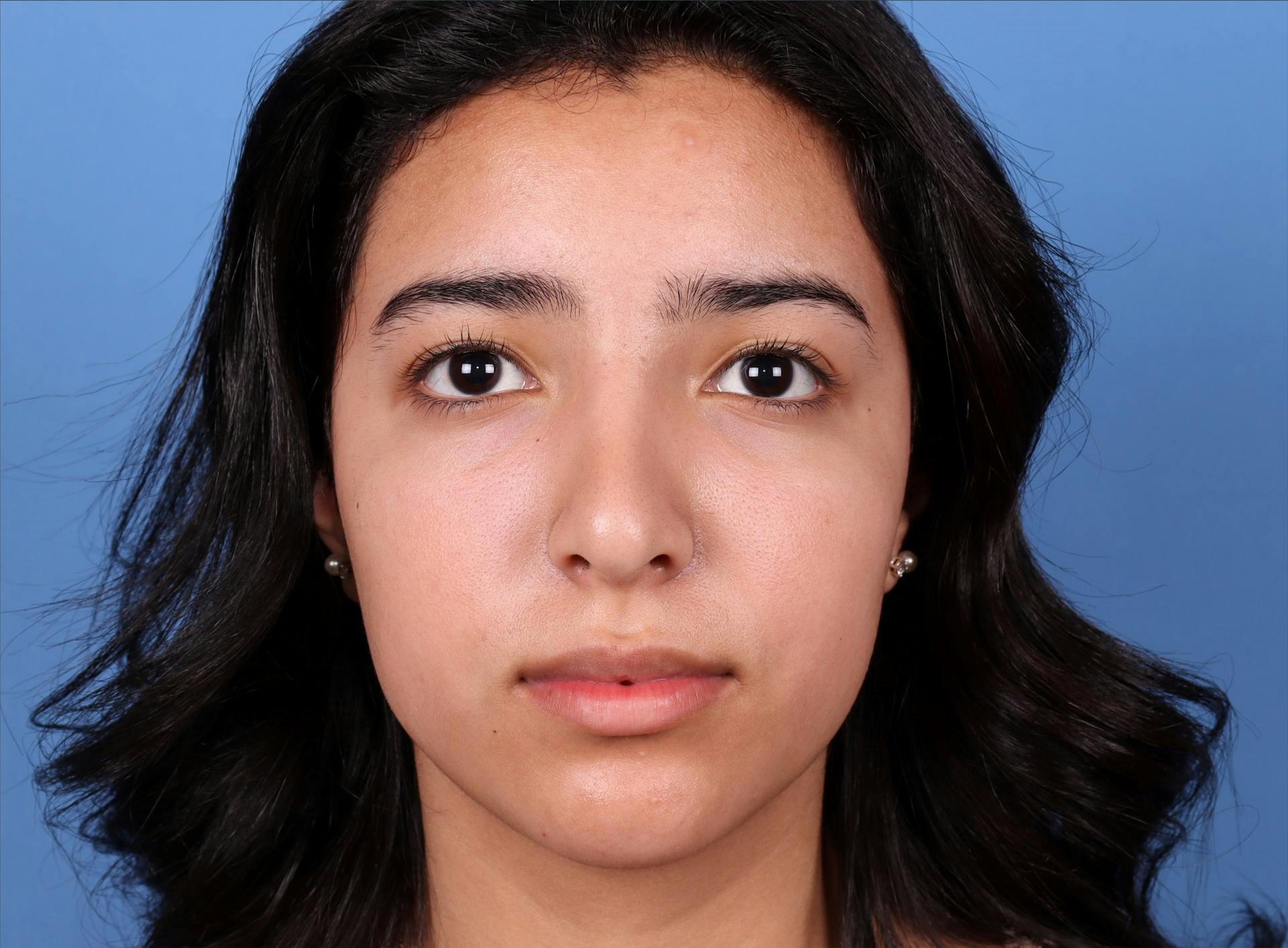 Rhinoplasty Before & After Gallery - Patient 64995415 - Image 6