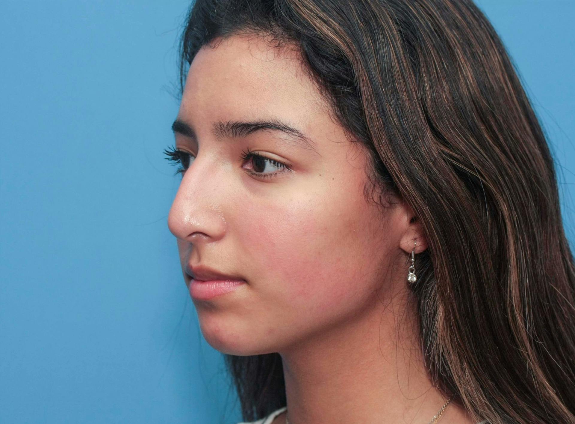 Rhinoplasty Before & After Gallery - Patient 64995415 - Image 3