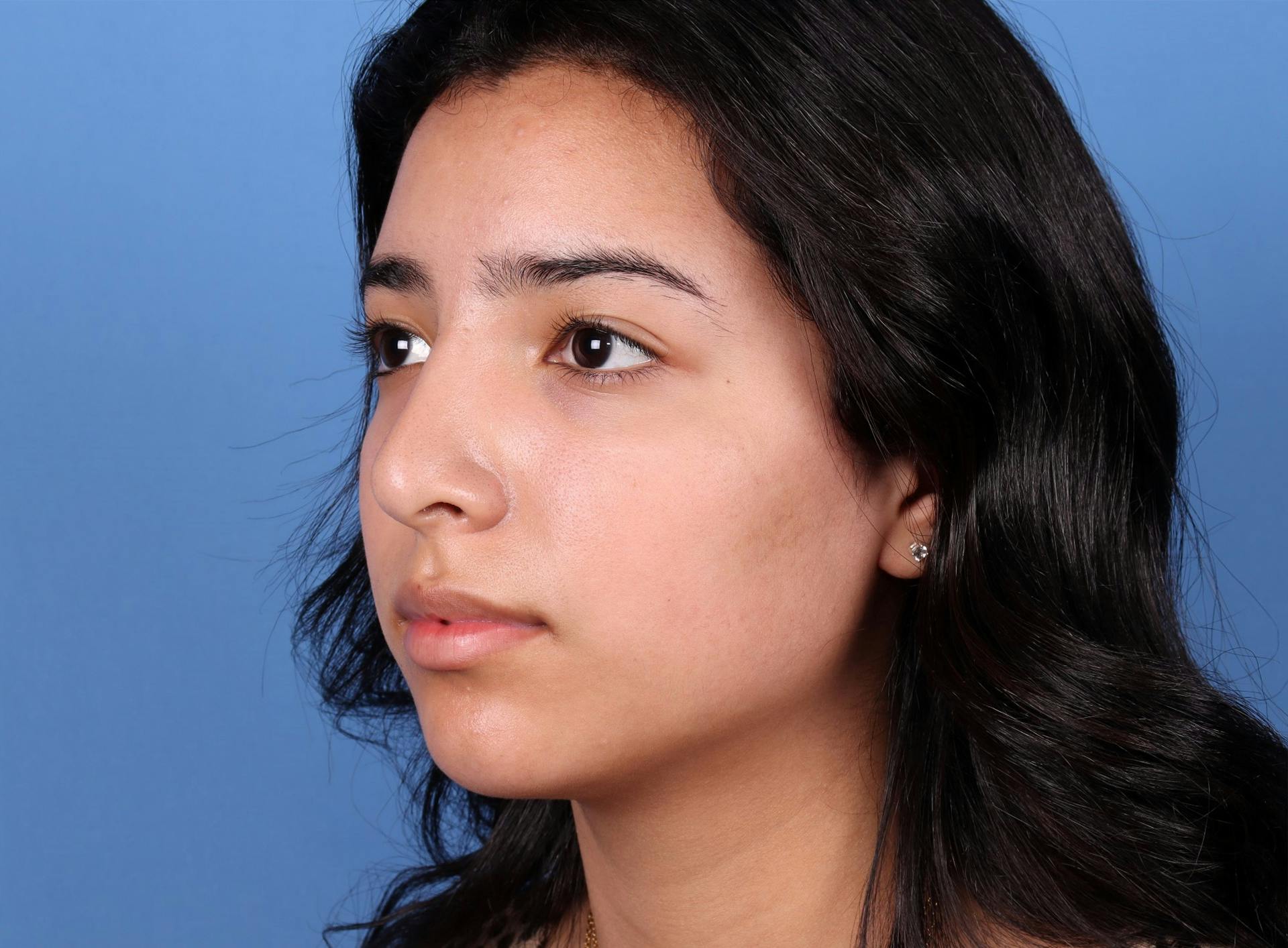 Rhinoplasty Before & After Gallery - Patient 64995415 - Image 4