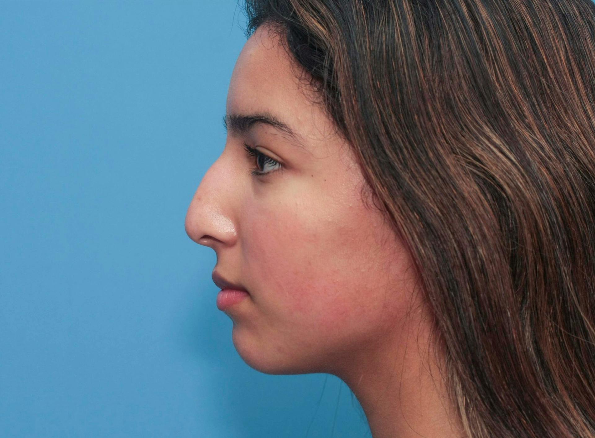 Rhinoplasty Before & After Gallery - Patient 64995415 - Image 1