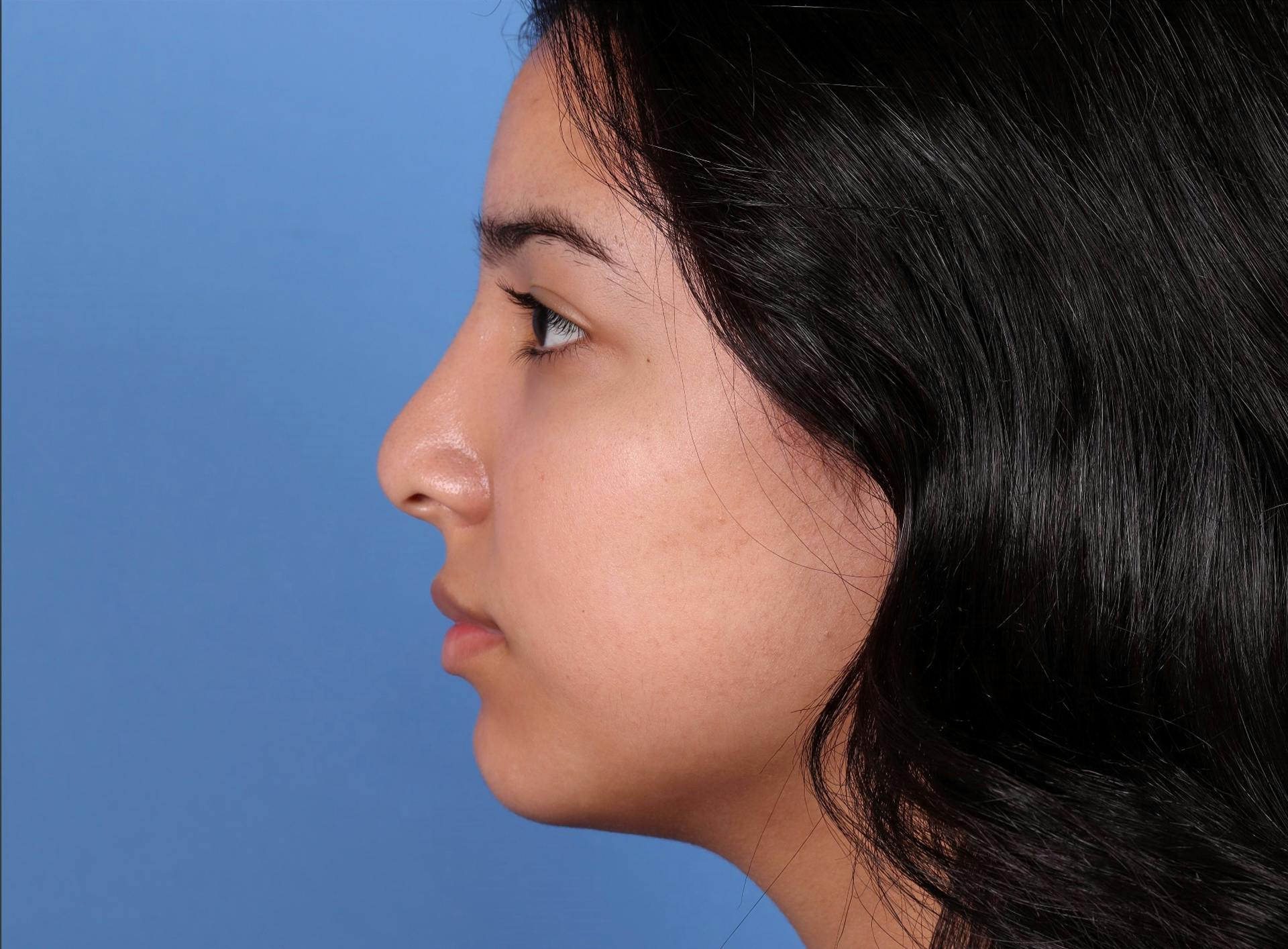Rhinoplasty Before & After Gallery - Patient 64995415 - Image 2