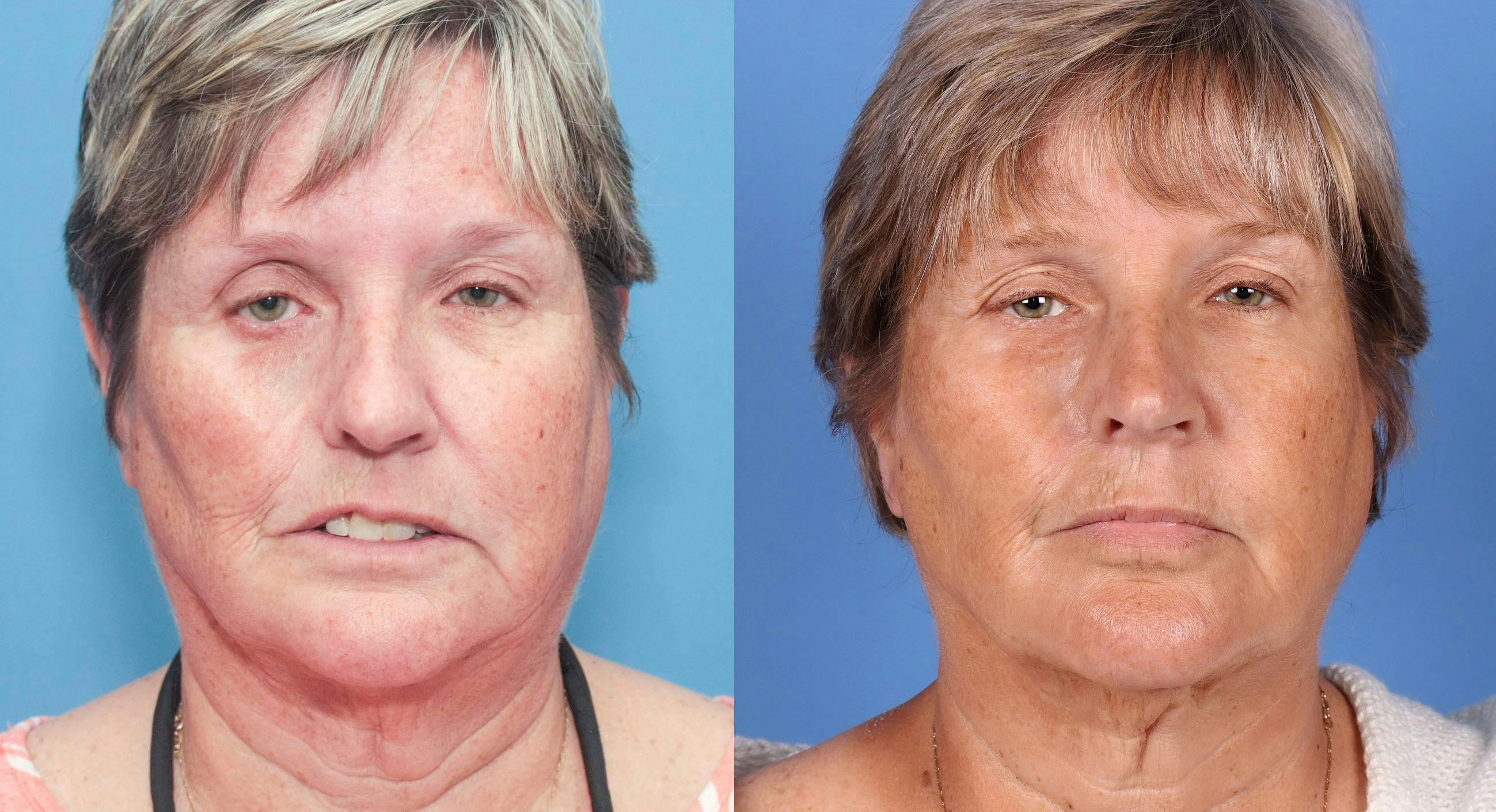 Fat Grafting Before & After Gallery - Patient 65810386 - Image 1