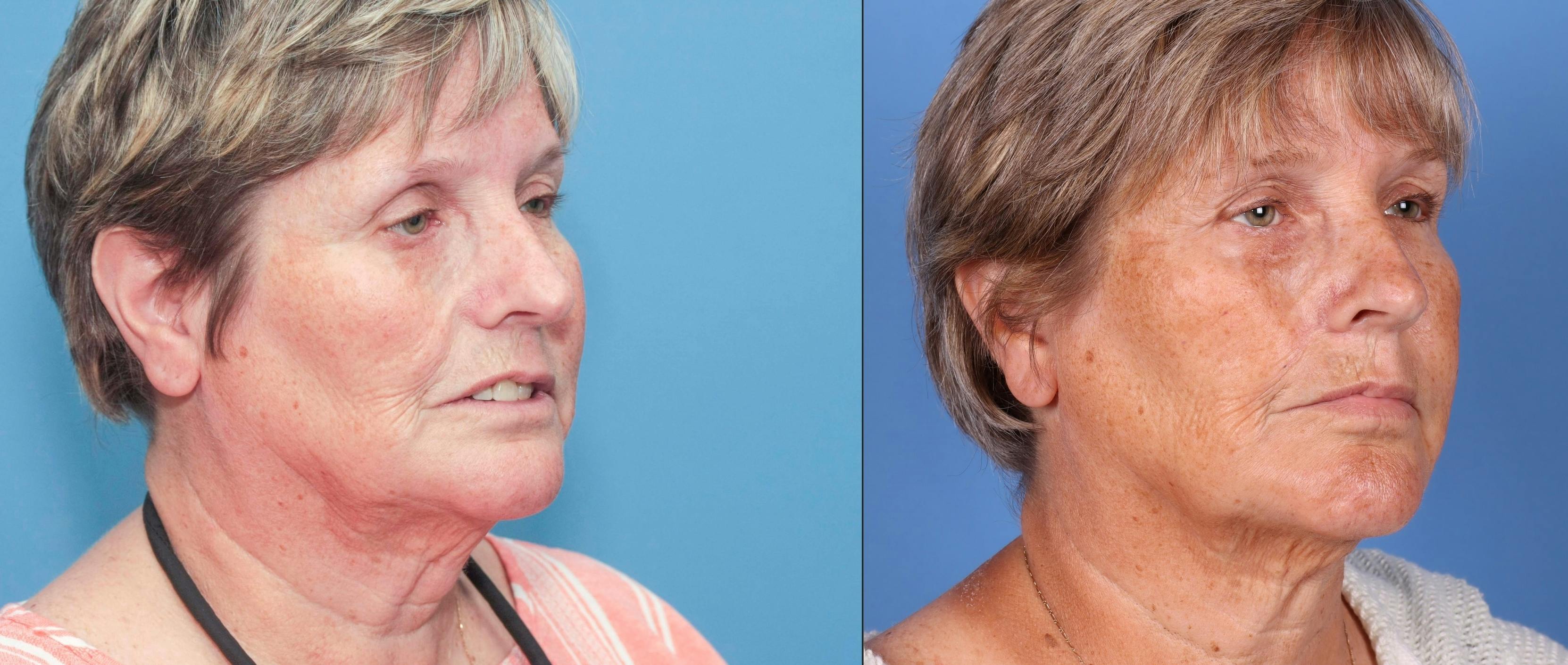 Fat Grafting Before & After Gallery - Patient 65810386 - Image 2