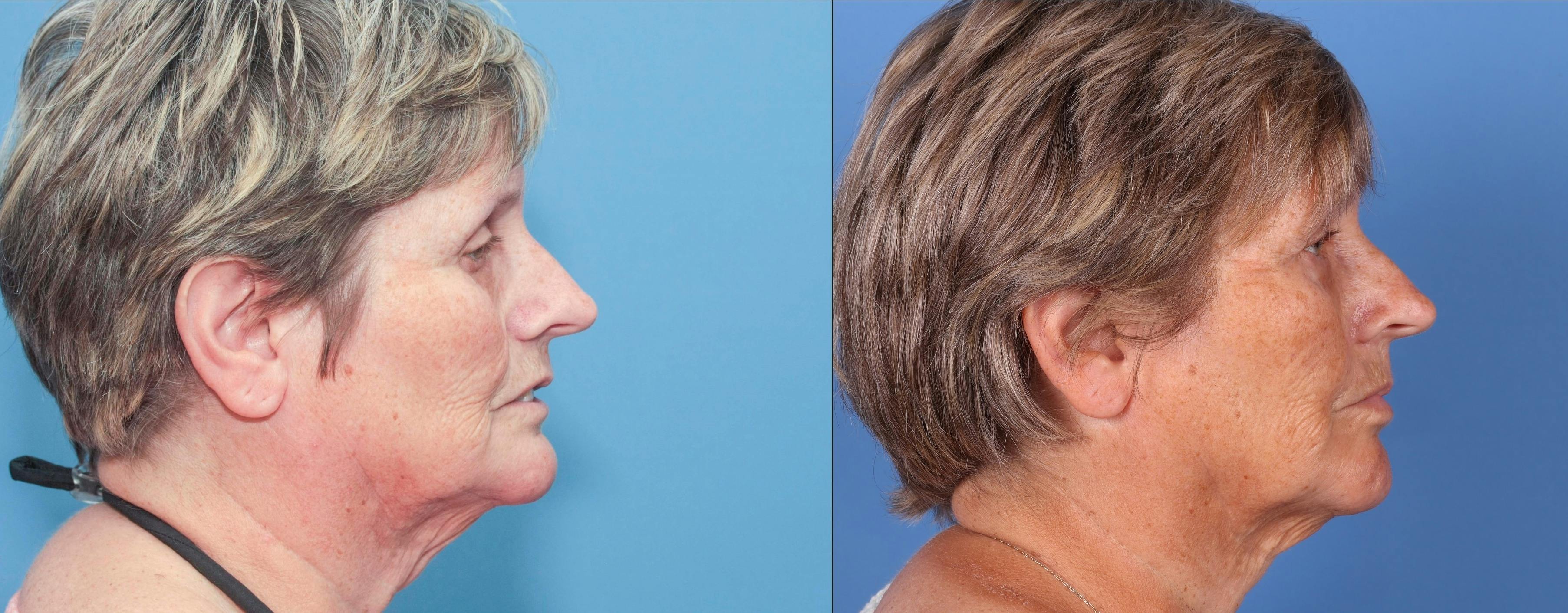 Fat Grafting Before & After Gallery - Patient 65810386 - Image 3