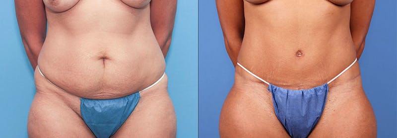 Abdomen Before & After Gallery - Patient 149385230 - Image 1