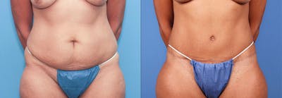 Tummy Tuck Before & After Gallery - Patient 66902222 - Image 1