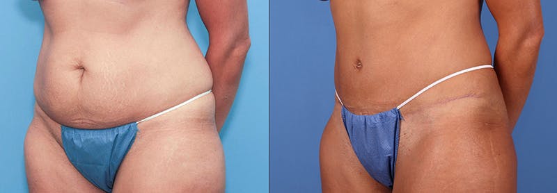 Tummy Tuck Before & After Gallery - Patient 66902222 - Image 2
