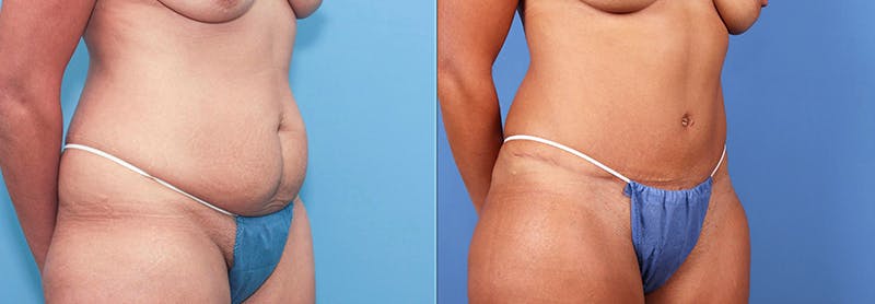 Abdomen Before & After Gallery - Patient 149385230 - Image 3