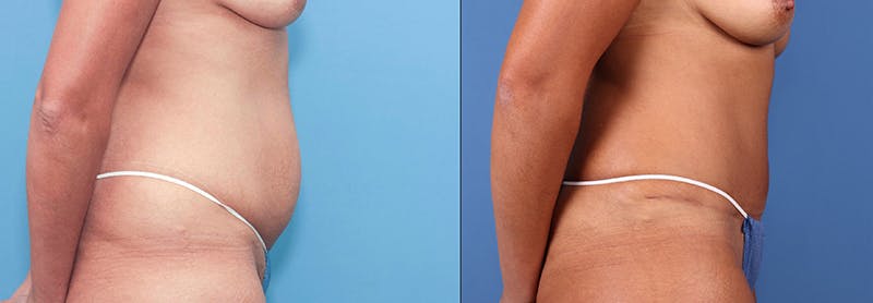 Tummy Tuck Before & After Gallery - Patient 66902222 - Image 4