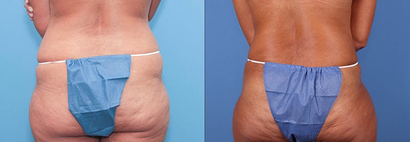 Abdomen Before & After Gallery - Patient 149385230 - Image 5