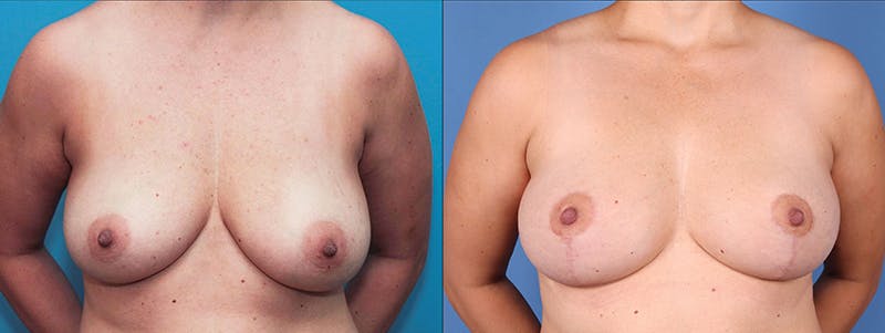 Breast Lift Before & After Gallery - Patient 66902451 - Image 1