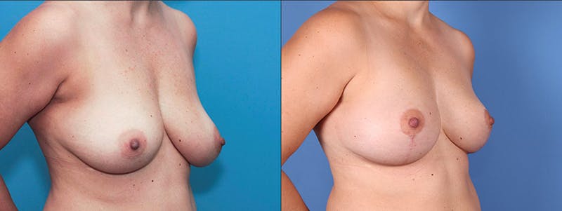 Breast Lift Gallery - Patient 66902451 - Image 2