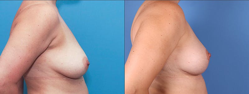 Breast Lift Before & After Gallery - Patient 66902451 - Image 3