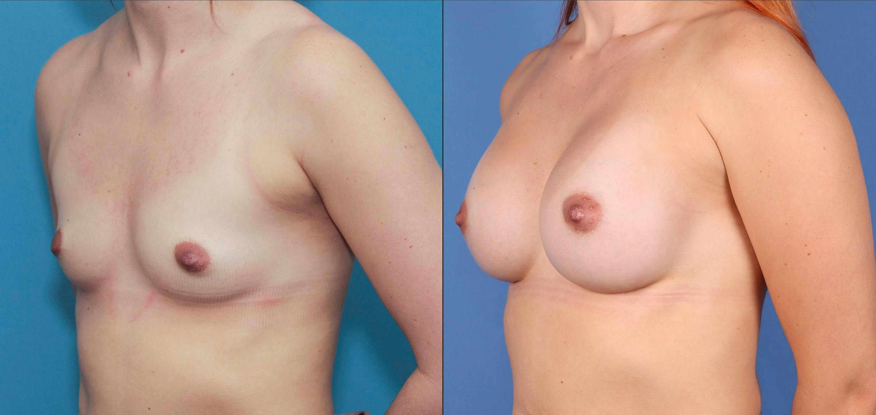 Breast Augmentation Before & After Gallery - Patient 67104594 - Image 2
