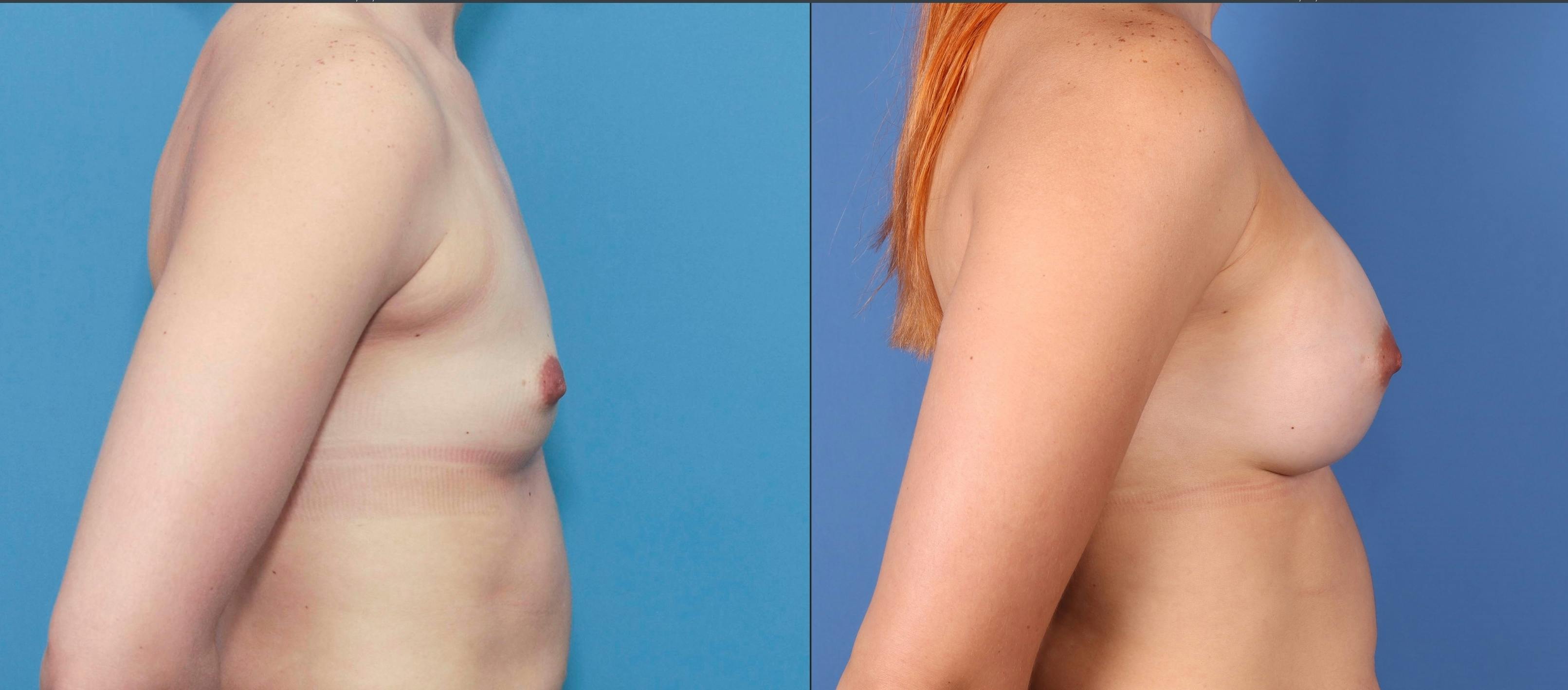 Breast Augmentation Before & After Gallery - Patient 67104594 - Image 4