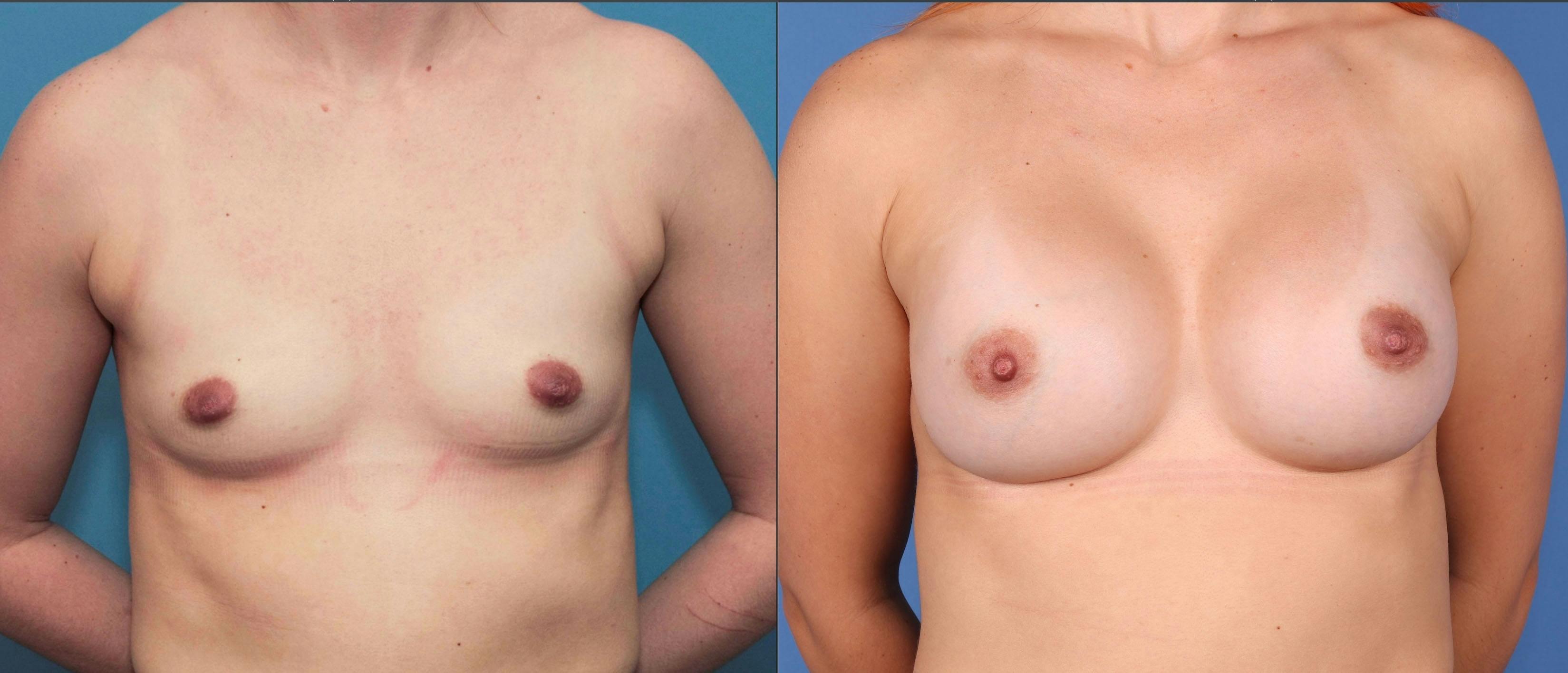 Breast Augmentation Before & After Gallery - Patient 67104594 - Image 1
