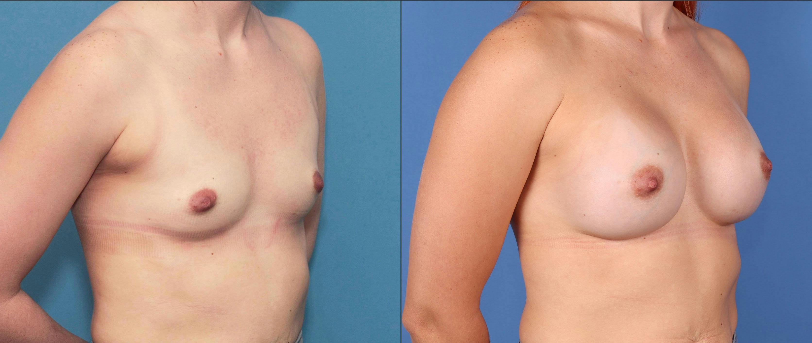 Breast Augmentation Before & After Gallery - Patient 67104594 - Image 5
