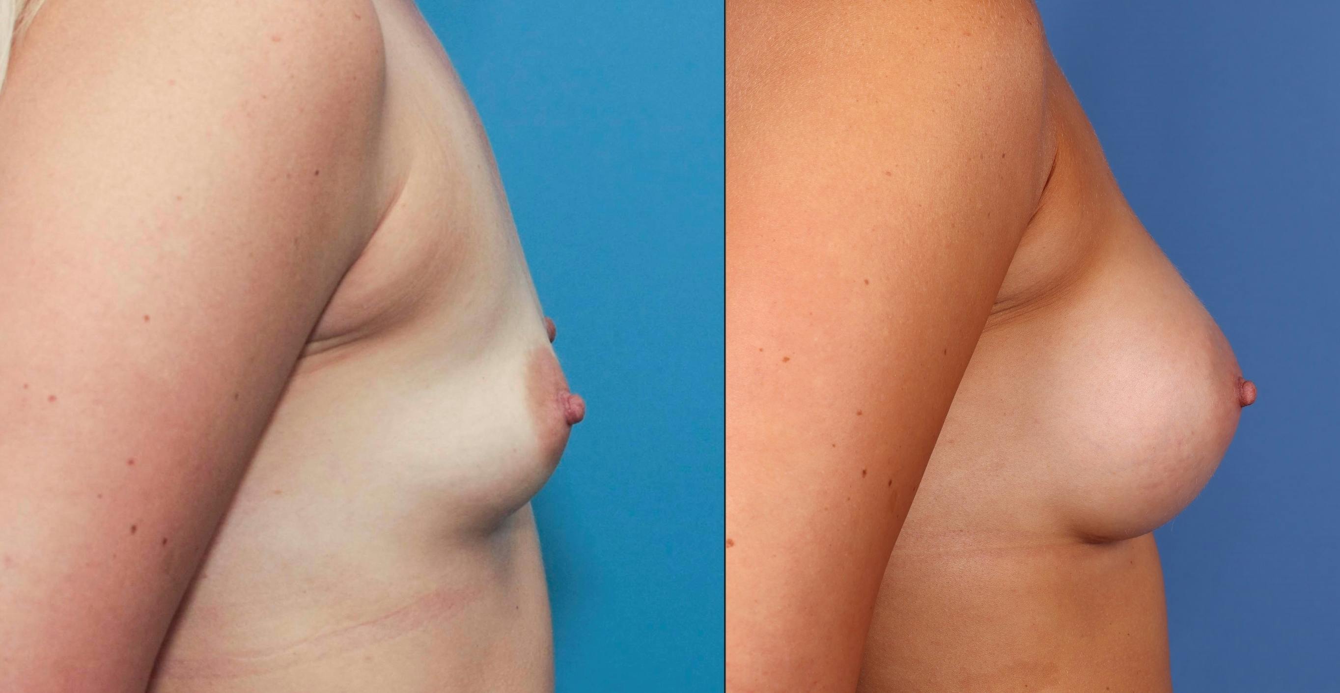 Breast Augmentation Before & After Gallery - Patient 68439649 - Image 3