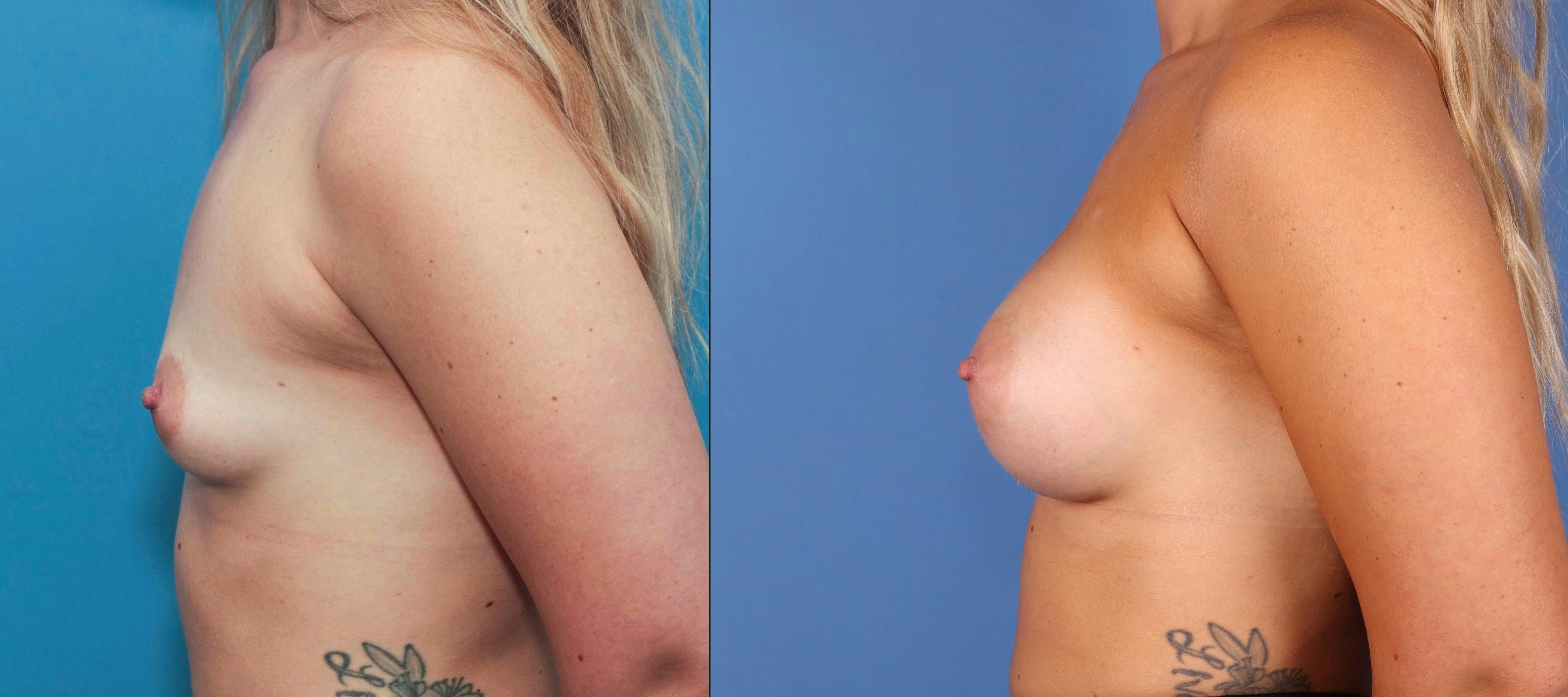 Breast Augmentation Gallery - Patient 68439649 - Image 5