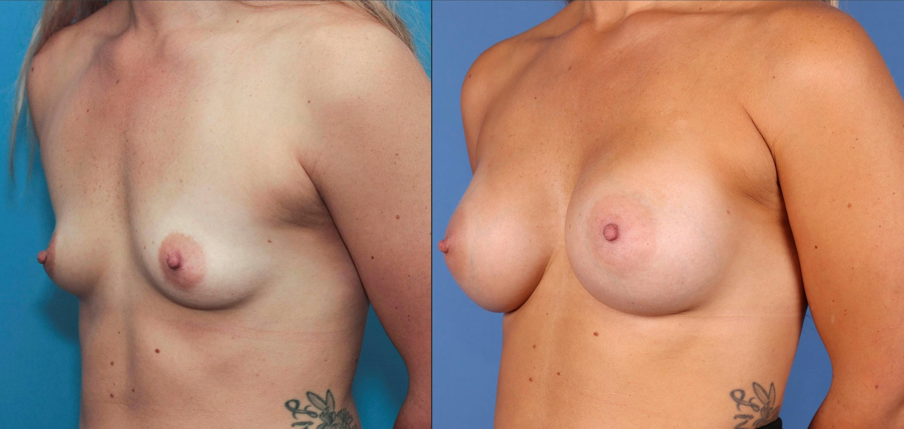 Breast Augmentation Gallery - Patient 68439649 - Image 4