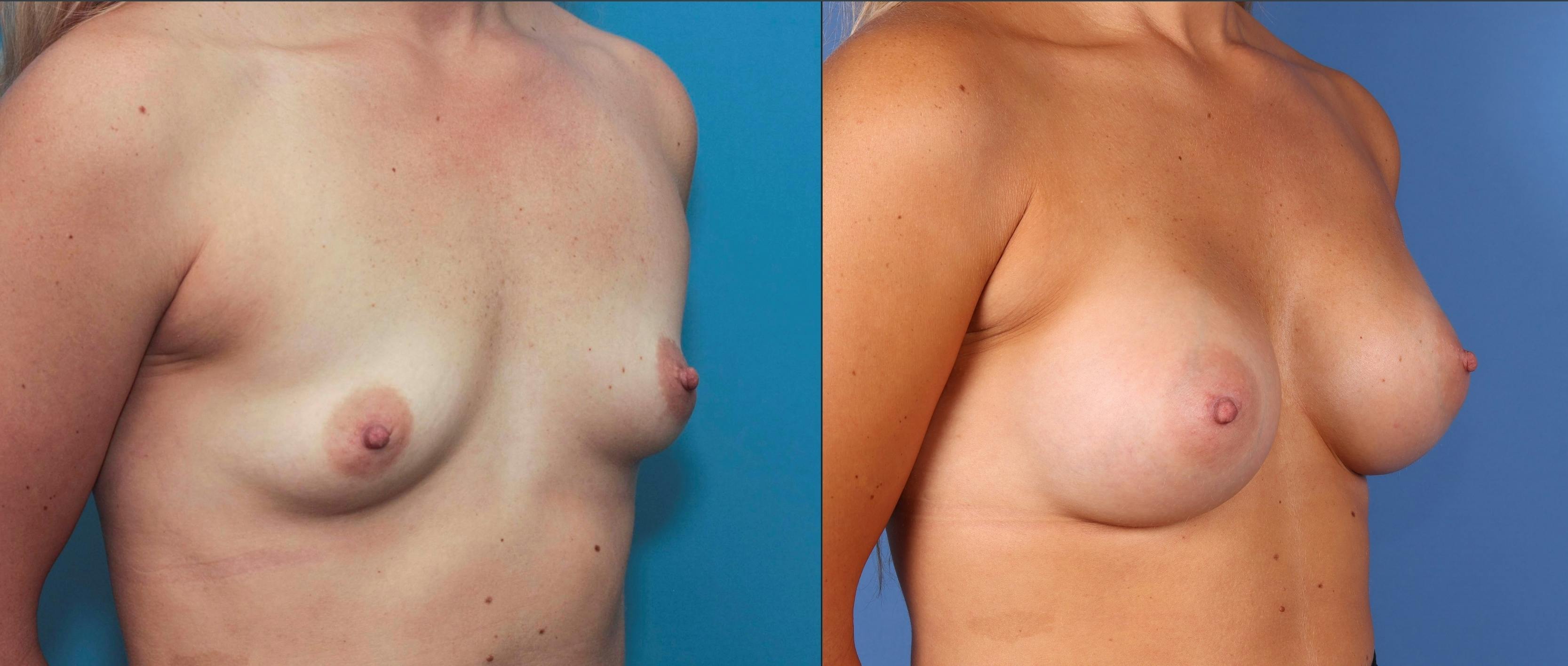 Breast Augmentation Gallery - Patient 68439649 - Image 2